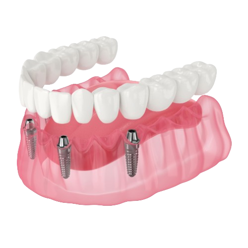 Basal-implants-prosthesis