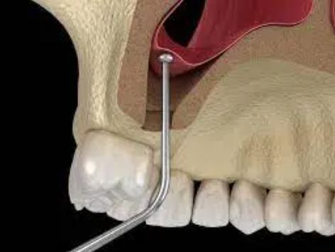 bone graft sinus lift