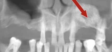 Dental bone graft for conventional dental implants
