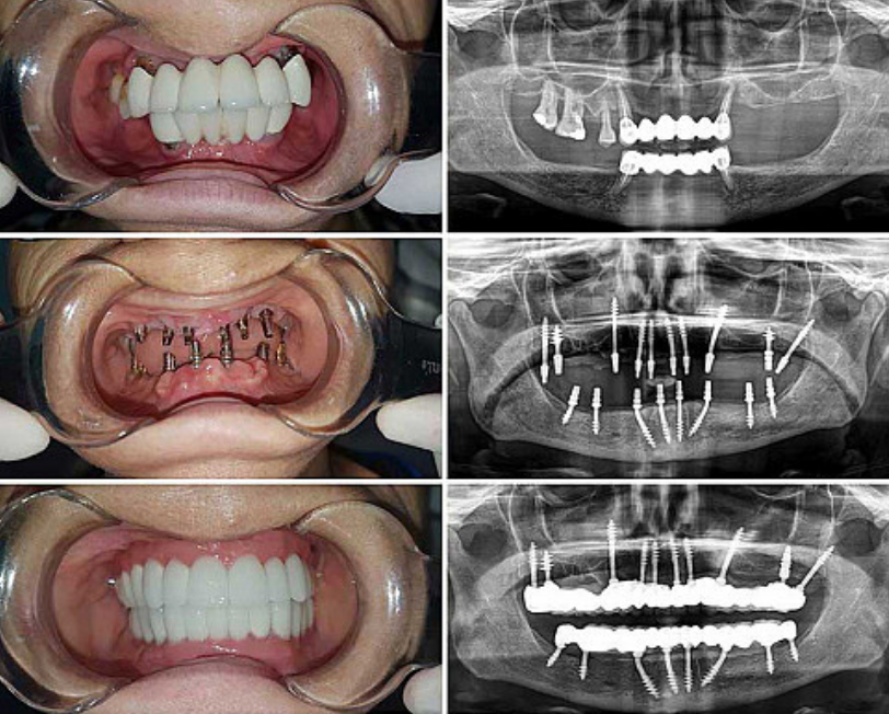 basal implants