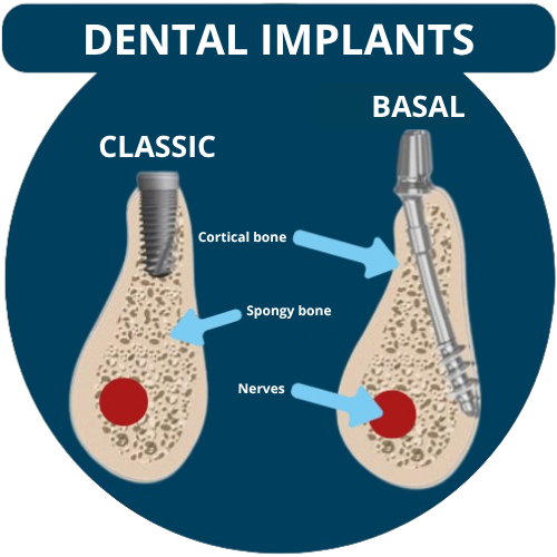 Basal dental implant anchored in cortical bone