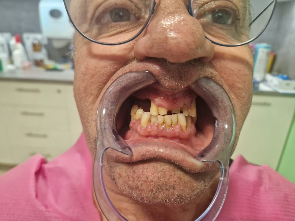 missing teeth