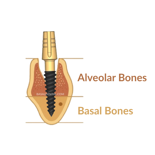 Basal implant with immediate loading