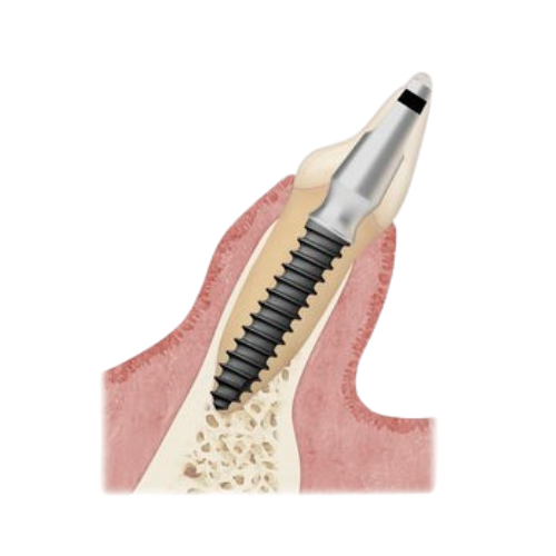 Basal implant