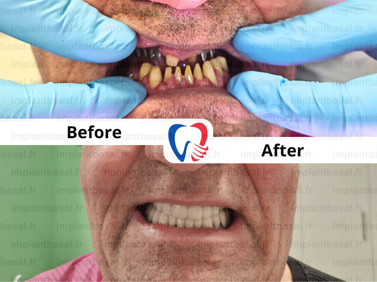 Full mouth dental implants before and after