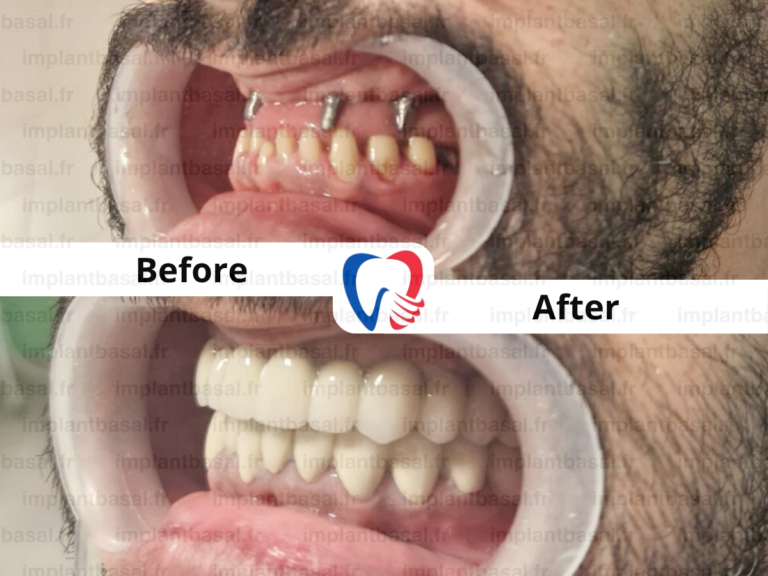 dental implant in turkey