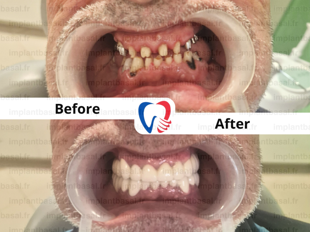 Dental implants for severe bone loss before and after