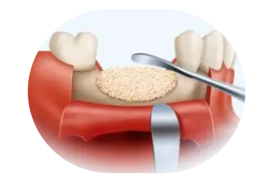 Bone graft