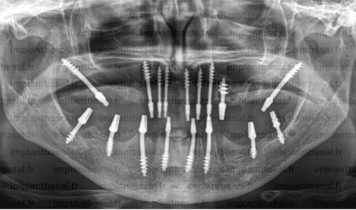 Basal implants vs conventional dental implants