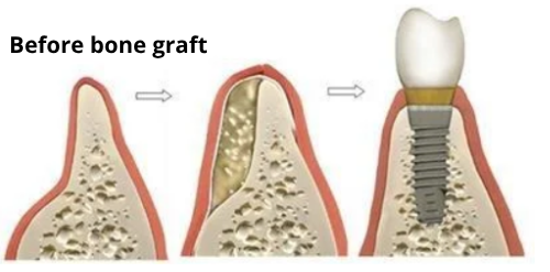 Jaw bone loss after tooth loss