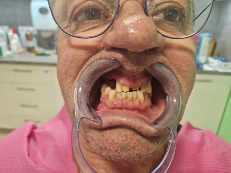 dental-implants-bone-loss