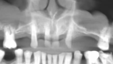 sinus without bone graft